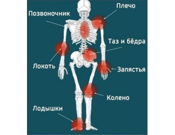 Почти пятая часть пациентов с ревматологическими заболеваниям во Франции используют для лечения терапевтические свойства конопли